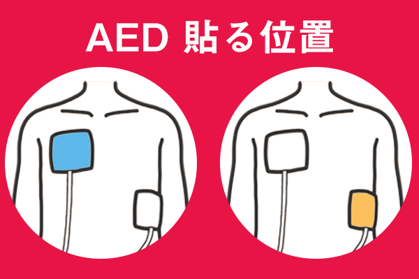 AEDの電極パッドを貼る位置は？正しい貼り方や注意点を解説