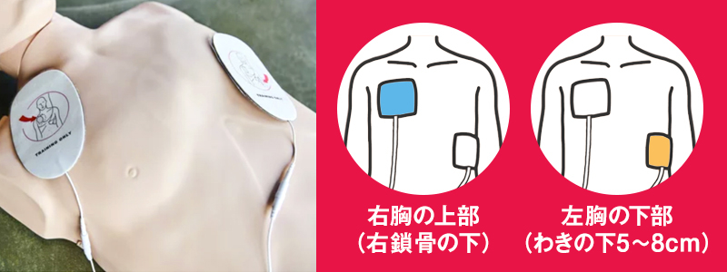 AEDの電極パッドを貼る位置