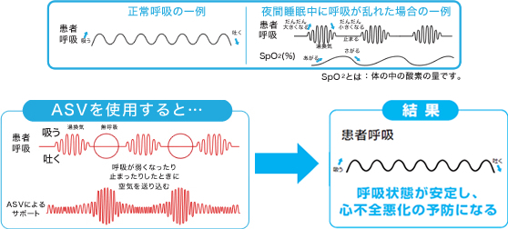 ASV治療イメージ